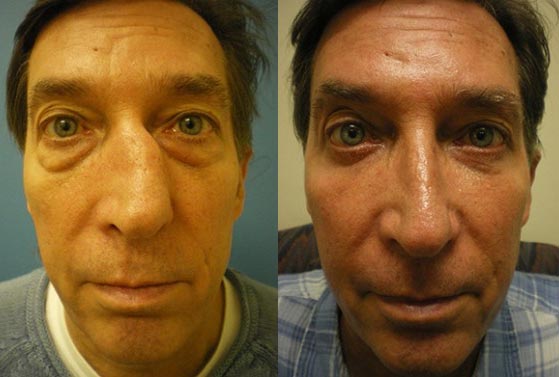 before after functional nasal surgery