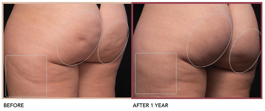 before after photo aveli cellulite treatment one