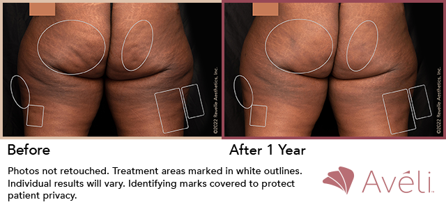 before after photo aveli cellulite treatment three