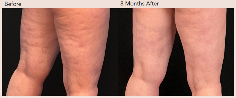 before after photo aveli cellulite treatment two
