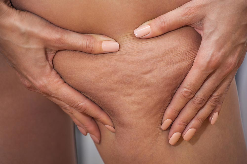 Girl shows holding and pushing the skin of the legs cellulite
