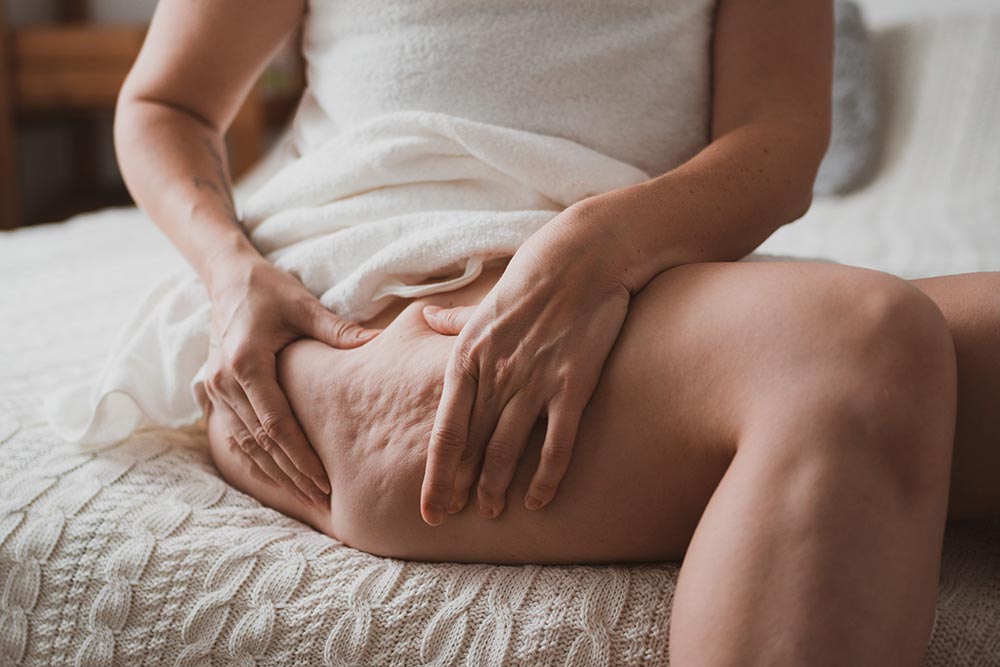 Close up of female body with cellulite, woman makes massage against cellulite with her hands.