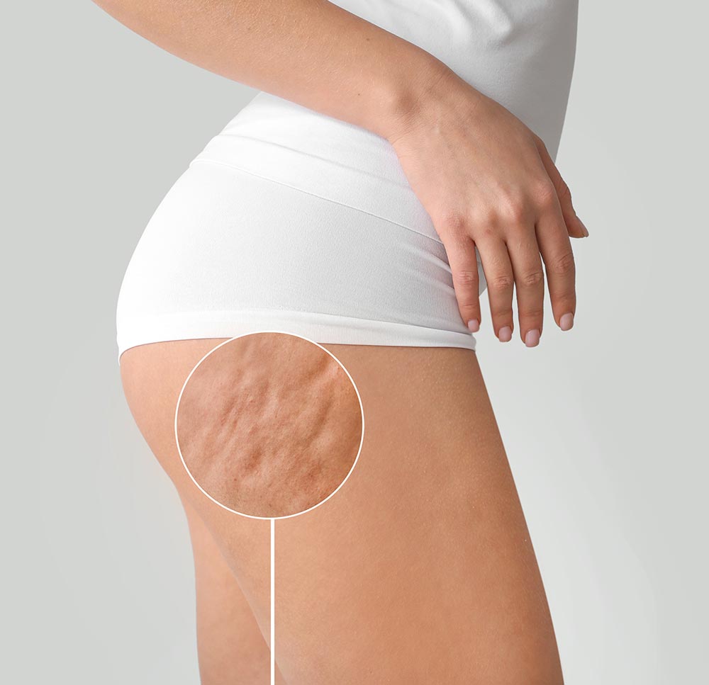 Young woman with cellulite problem on light background