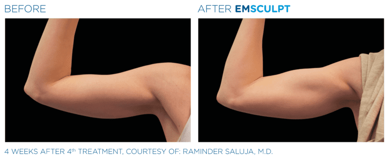 emsculpt before and after patient four