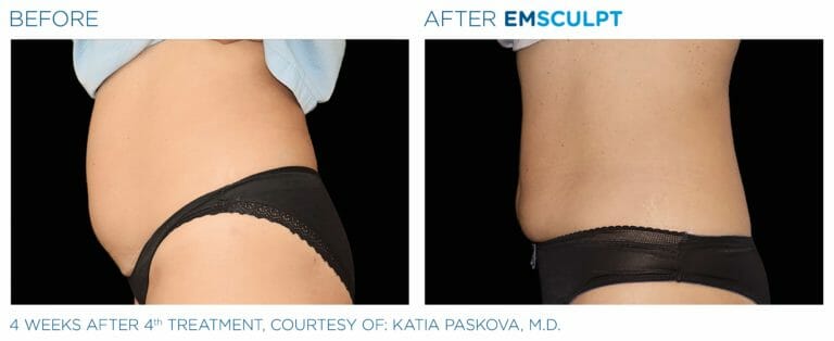 emsculpt before and after patient one