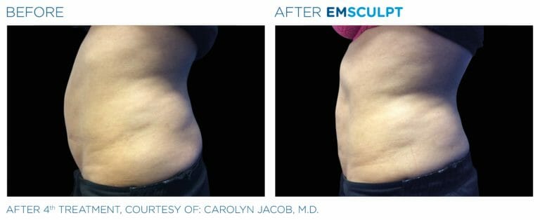emsculpt before and after patient three