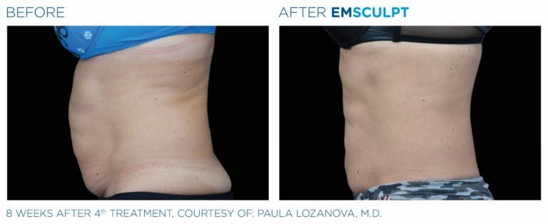 emsculpt before and after patient two