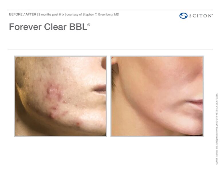 forever clear bbl image bxa