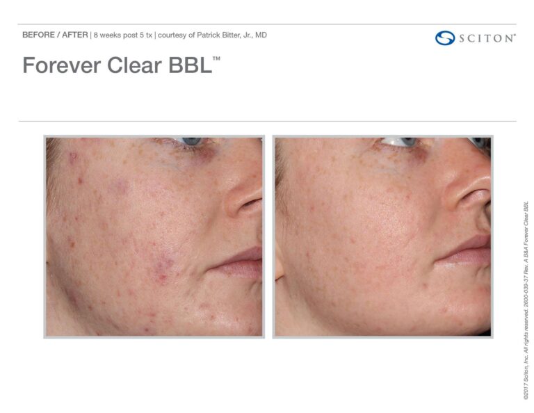 forever clear bbl image