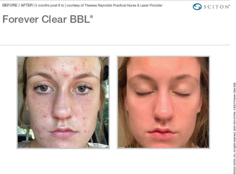 forever clear bbl images