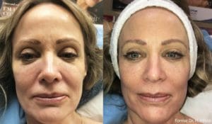forma facial before and after patient image