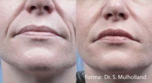 forma facial before and after patient pic