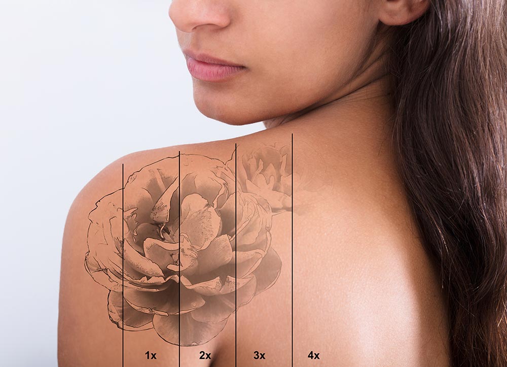 Tattoo Removal On Woman's Shoulder<br />
