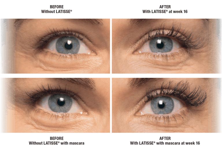 Latisse before and after chart