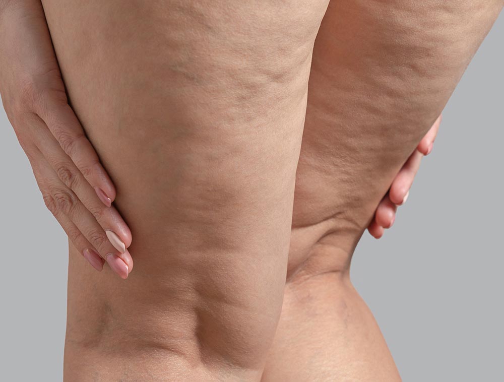 Stretch marks, cellulite and varicose veins on female legs.