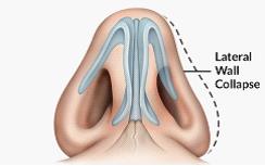 nasal valve lateral wall collapse