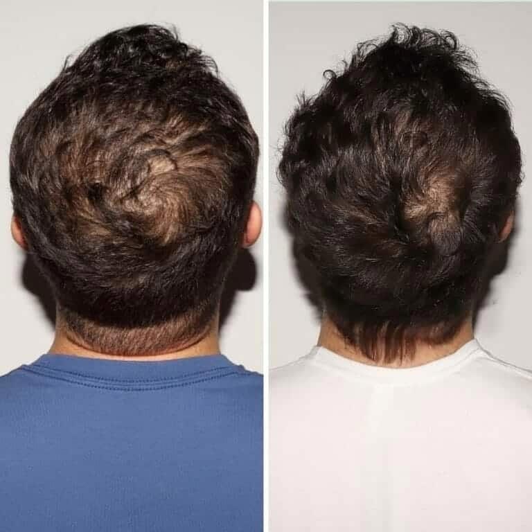 nutrafol before after slider image four