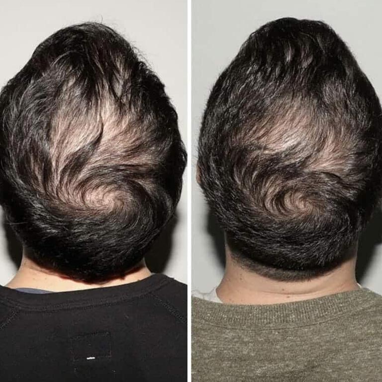 nutrafol before after slider image six