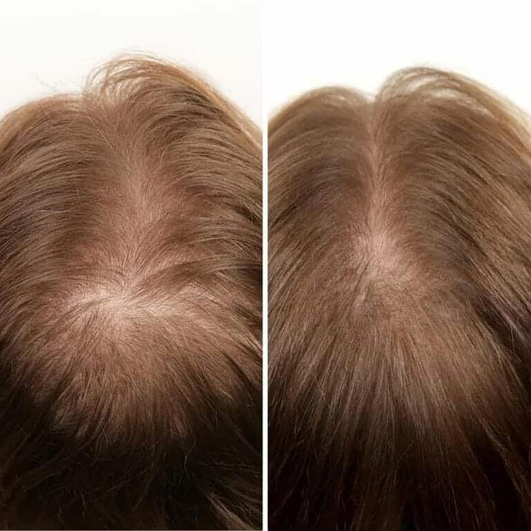 nutrafol before after slider image two