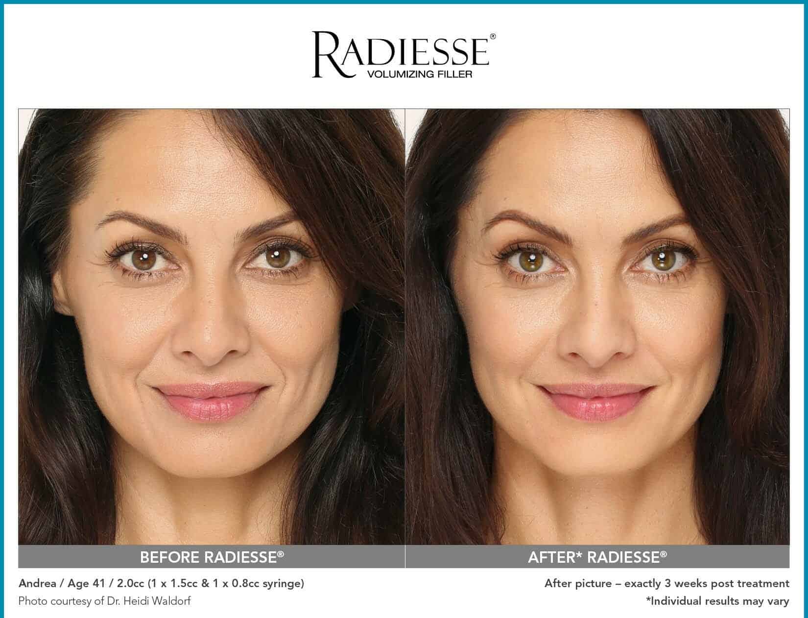 radiesse before after chicago