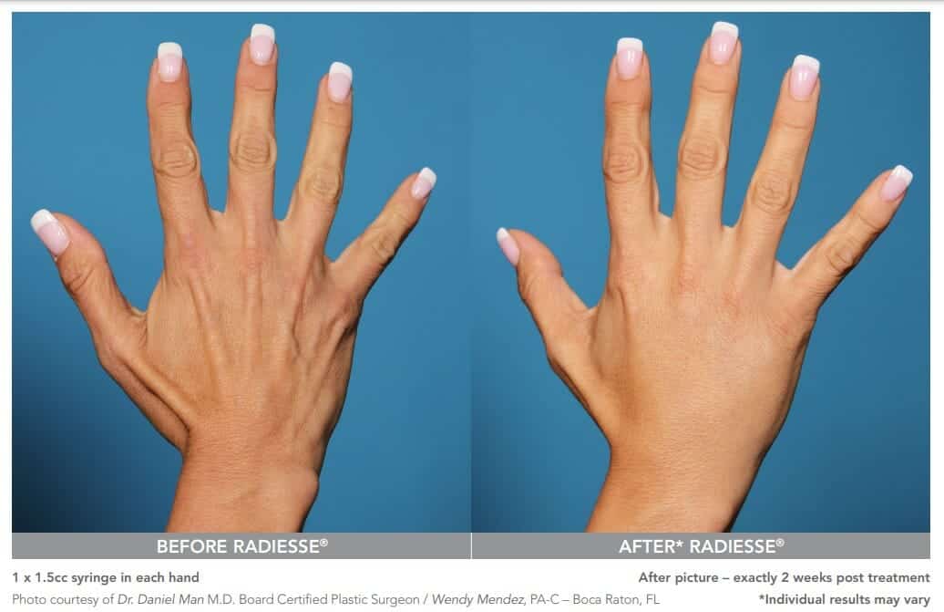 radiesse hands before after chicago