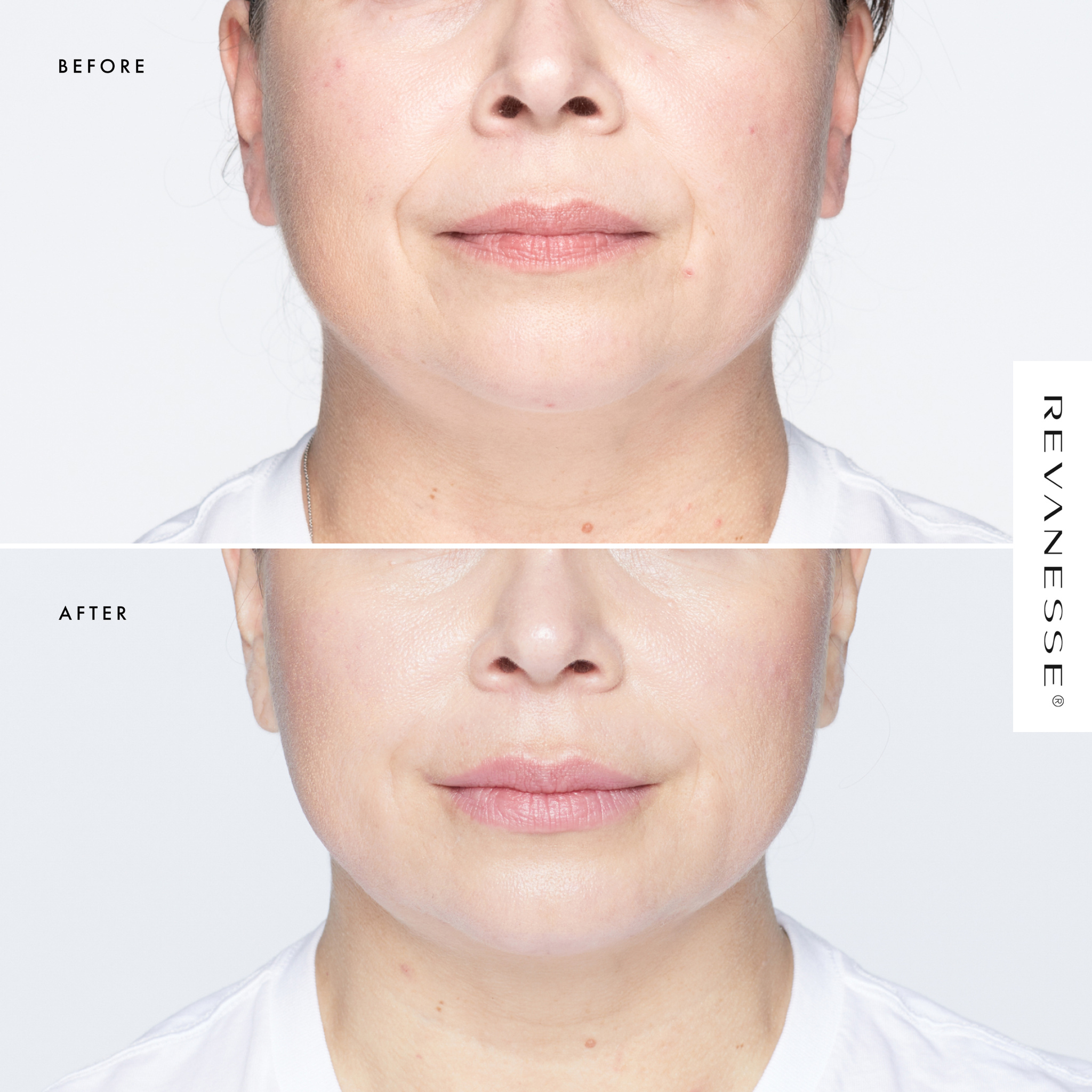 revanesse before after images
