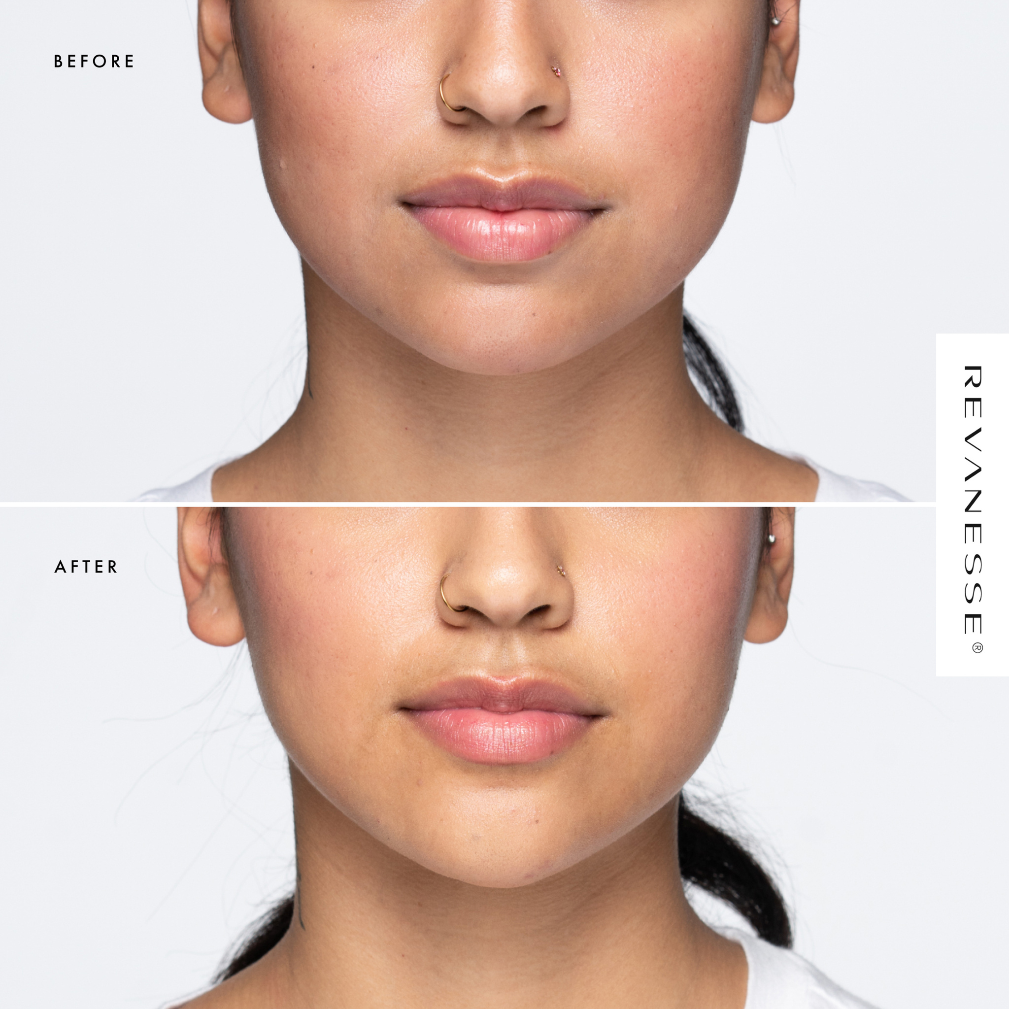 revanesse before after