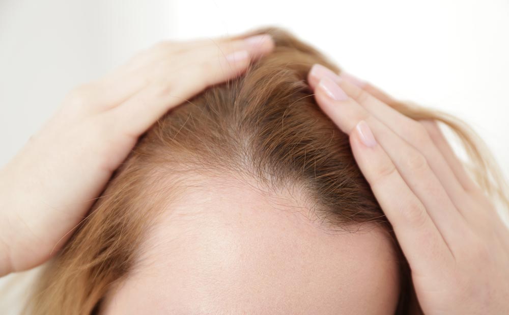 Young woman with hair loss problem on light background, closeup