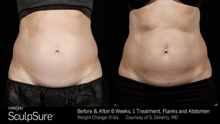 sculpsure before and after patient case three