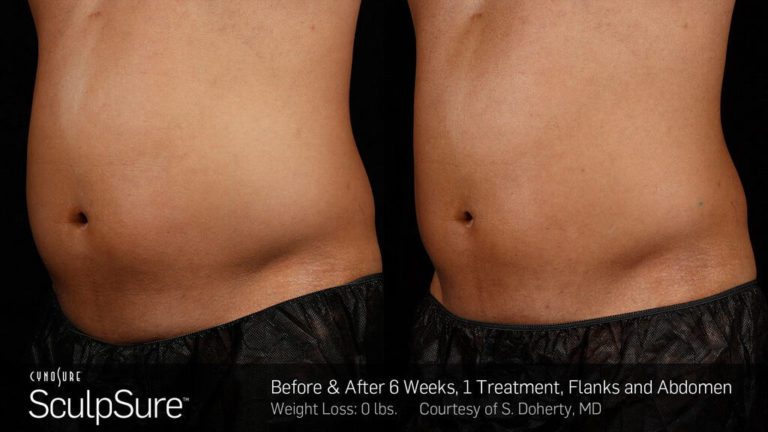 sculpsure before and after patient case two