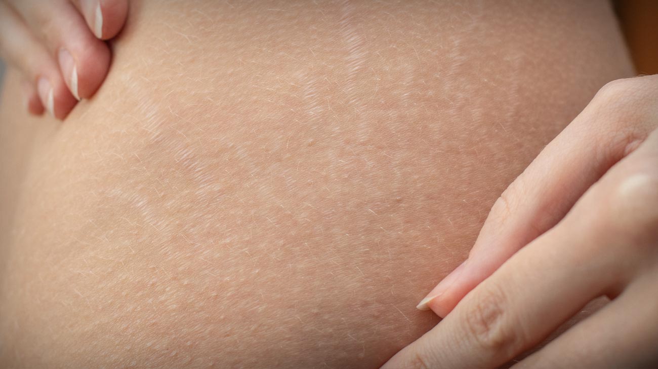 Woman hips with visible stretch marks