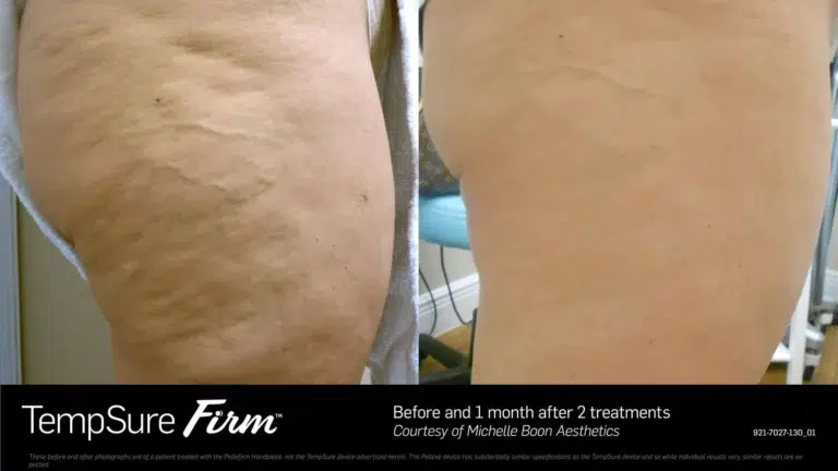 tempsure cellulite reduction before and after patient one