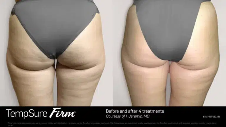 tempsure cellulite reduction before and after patient three