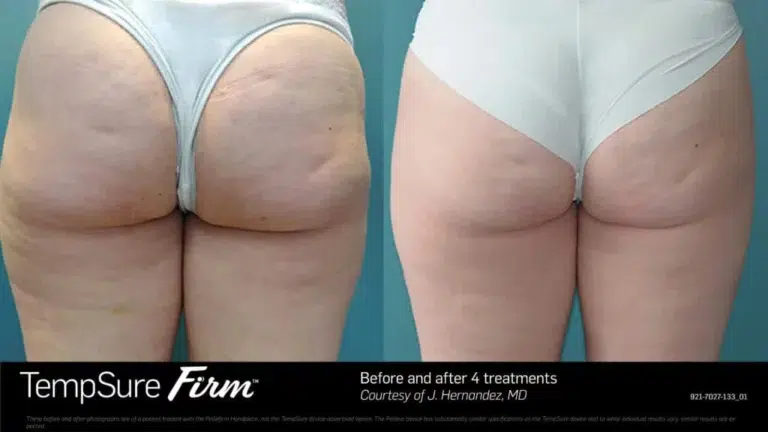 tempsure cellulite reduction before and after patient two