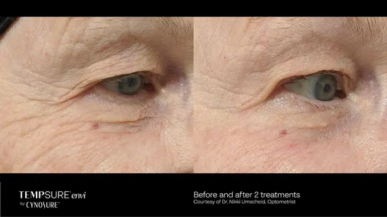 tempsure skin tightening before and after patient two