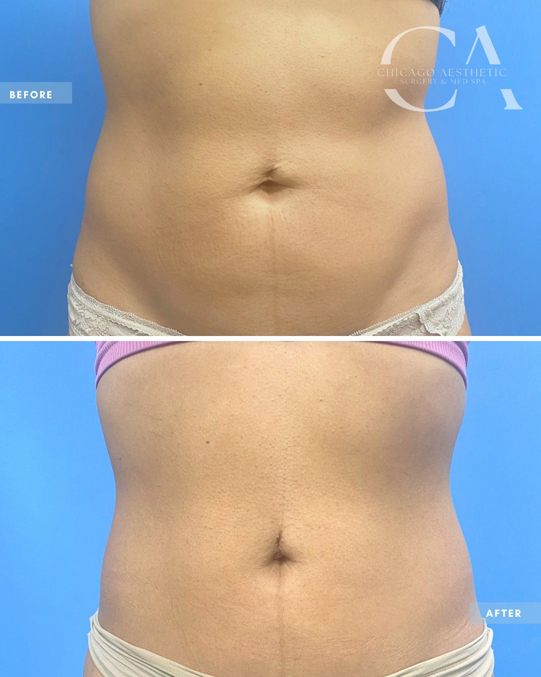 1682152 Morpheus8 Body Abdomen Lift Alison Falada Chicago 3Tx (3)