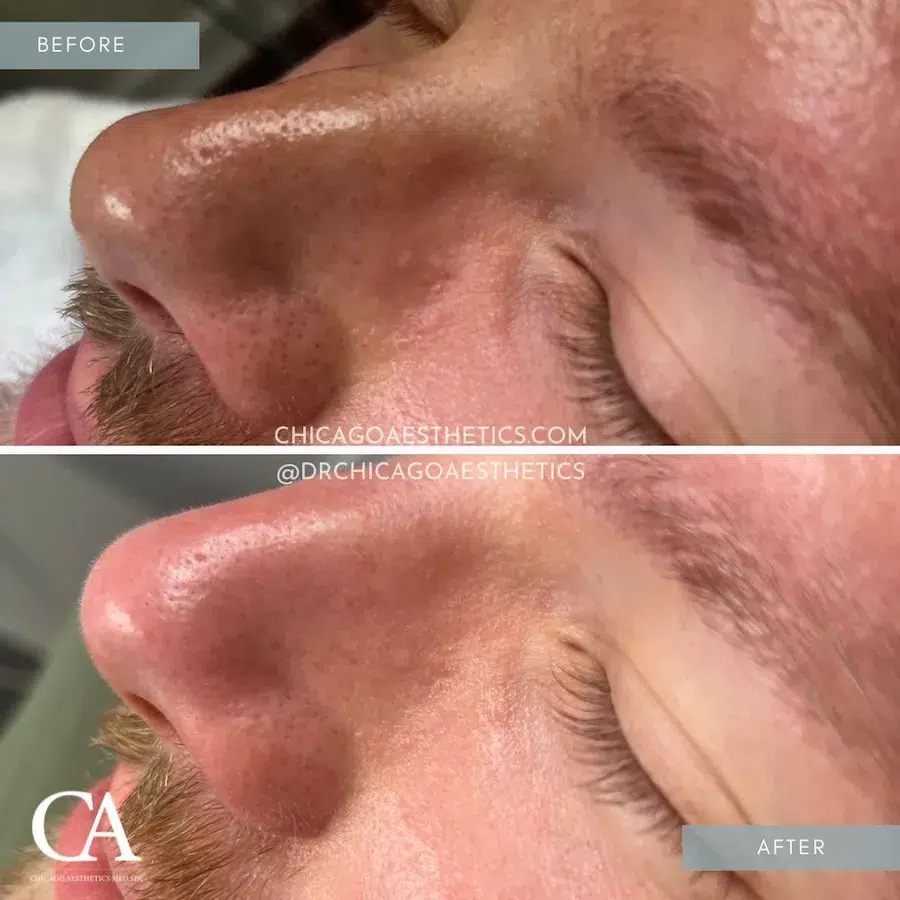 hydrafacial before and after