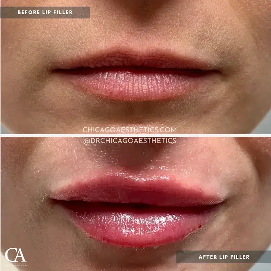 lip filler before and after