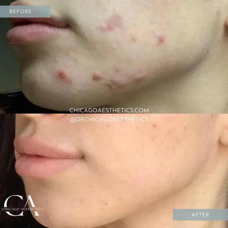 microneedling before and after