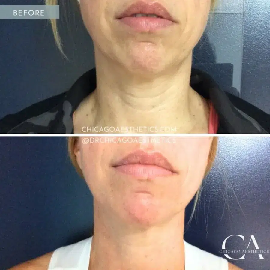 morpheus eight before and after