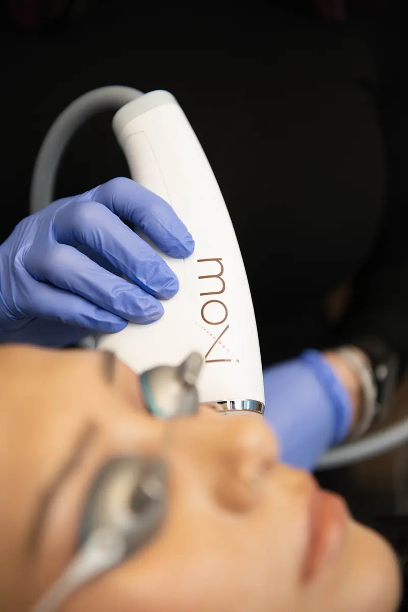 Top Winter Skincare Treatments patient receiving moxi treatement
