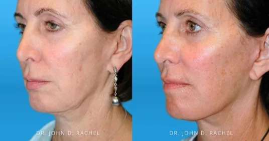Before and after mini facelift result by Dr. Rachel