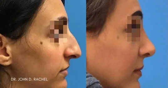Before and after rhinoplasty result by Dr. Rachel